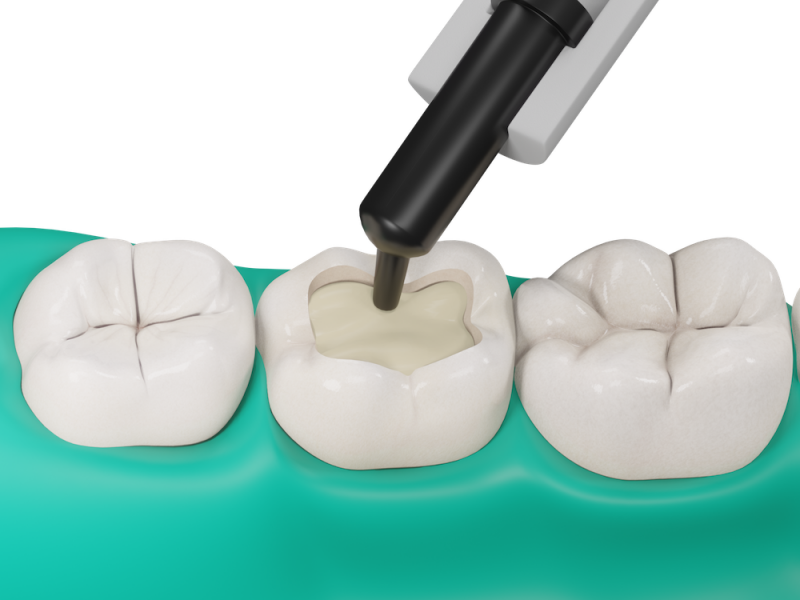 Fibrafill DENTIN aplikace
